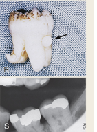 <ul><li><p>misplaced ameloblasts migrated to the surface of root by localized failure of HERs to separate from dentin</p></li><li><p>enamel ectopically forms over cemental root surface </p></li><li><p>small spherical enamel projection on root especially at CEJ</p></li></ul><p></p>