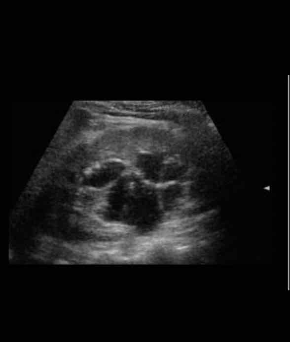 <p>What type of renal cyst is this? <span>– lymphatic cysts in the central sinus, usually multiple</span></p>