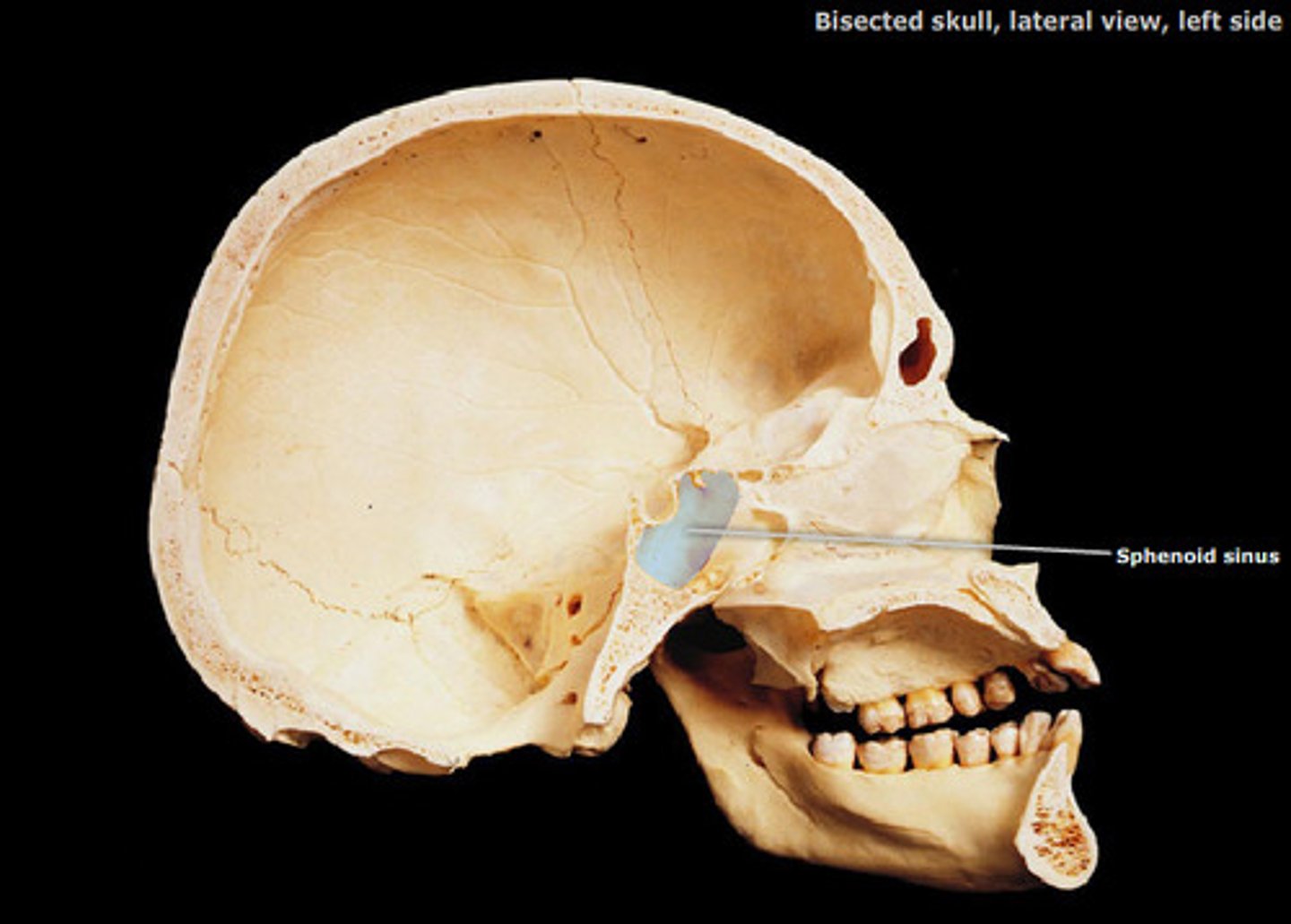 <p>Central part of sphenoid bone is riddled with air cavities.</p>