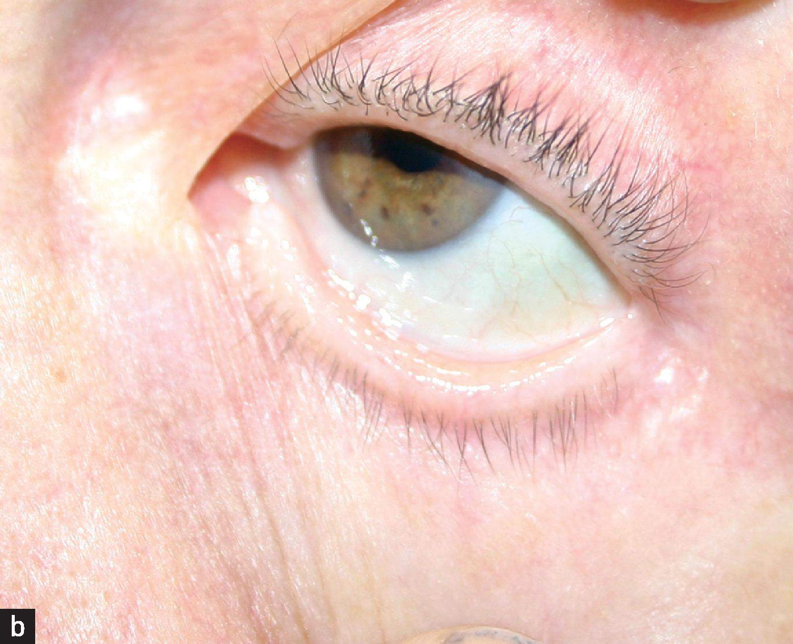 <ul><li><p><strong>conjunctival pallor</strong></p></li><li><p><span>tachycardia </span></p></li><li><p><span>systolic murmur</span></p></li></ul><p></p>