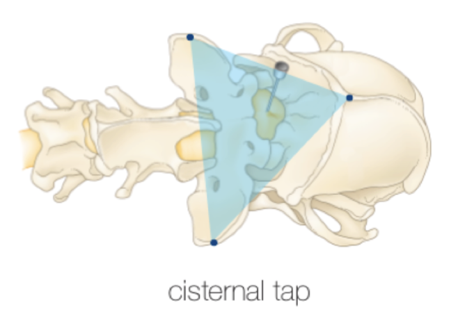 <ul><li><p>Flexion of the neck</p></li><li><p>Enter in the midline between the skill and C1</p></li><li><p>Stop advancing when entering the CSF space </p></li></ul><p></p><p></p>