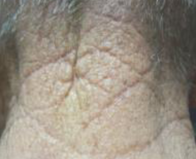 <p>deep wrinkles on posterior neck in “crisscross” pattern</p>