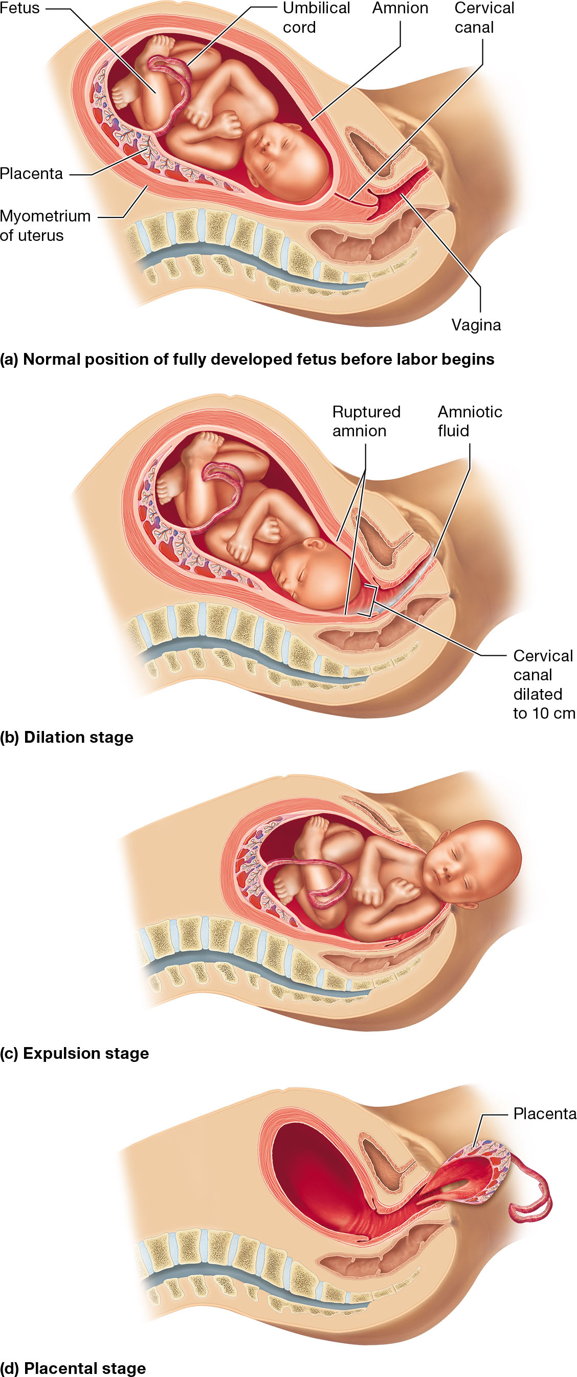 <p><strong>Dilation Stage</strong><span><span>: This is the longest stage, lasting 8–24 hours for first-time mothers and 4–12 hours for those who have given birth before. It begins with labor onset and ends when the cervix is fully dilated to 10 cm. Contractions start in the upper uterus and move downward, becoming stronger as labor progresses. The amnion ruptures, releasing amniotic fluid, known as "water breaking."</span></span></p><p><strong>Expulsion Stage</strong>: This stage lasts from full dilation to the delivery of the newborn, typically 30 minutes to 1 hour. Strong contractions occur, and the mother may push to aid delivery. Crowning occurs when the fetus's head distends the vagina. The umbilical cord is clamped and cut after delivery.</p><p><strong>Placental Stage</strong>: Following the baby's delivery, the placenta and fetal membranes are expelled from the uterus.</p><p></p>
