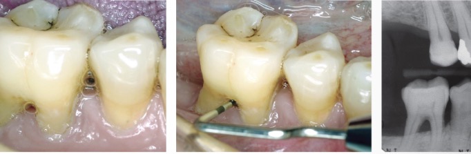 <p>on a multi-rooted tooth when periodontal infection invades the area between and around the roots, resulting in a loss of alveolar bone between the roots of a multirooted tooth </p>