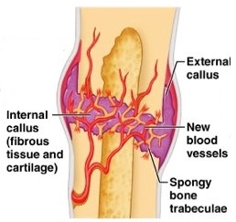 Semi-rigid union of cartilage matrix and granulation tissue splinting bones together. replaces haematoma.
