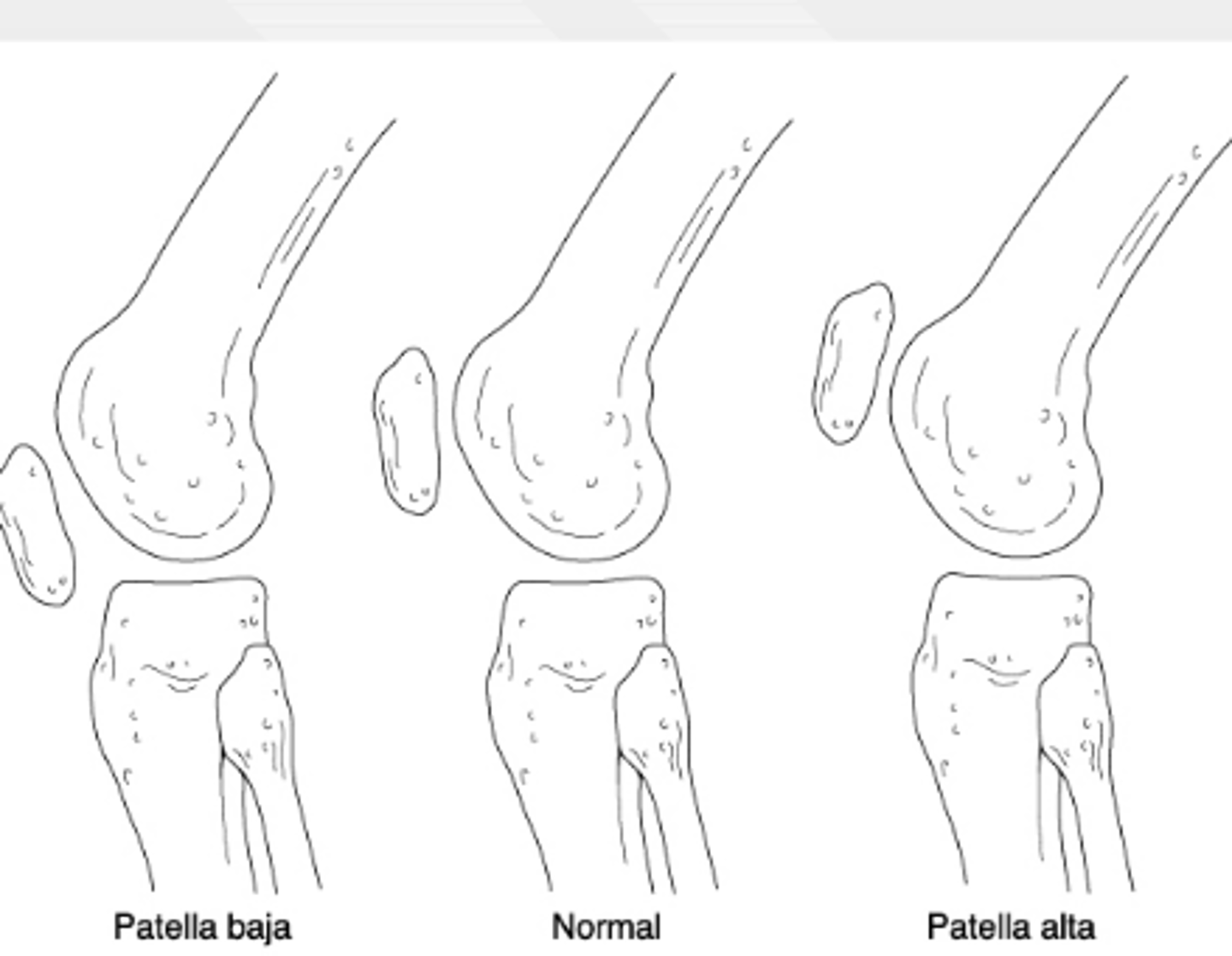 <p>patellar tendon rupture → patella alta on XR</p>
