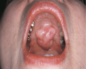 <p>A segment or lobe that is a part of the whole lesion; these lobes sometimes appear fused together</p>