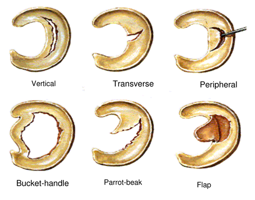 •Mild to moderate pain (everywhere)
- generally hurt in the morning, at night, moving up and down stairs. 
 Varying locations (front, back, sides). 
 With terminal degrees of ROM
•Diffuse swelling
•Loss of Range of motion (because of swelling or mechanical blockage). 
•Feeling of instability or weakness
•Locking
Bilitibal Patellar = can tell it's swollen.