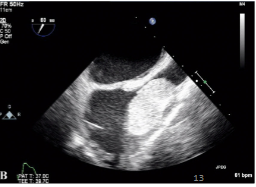 <p>Lipoma</p>