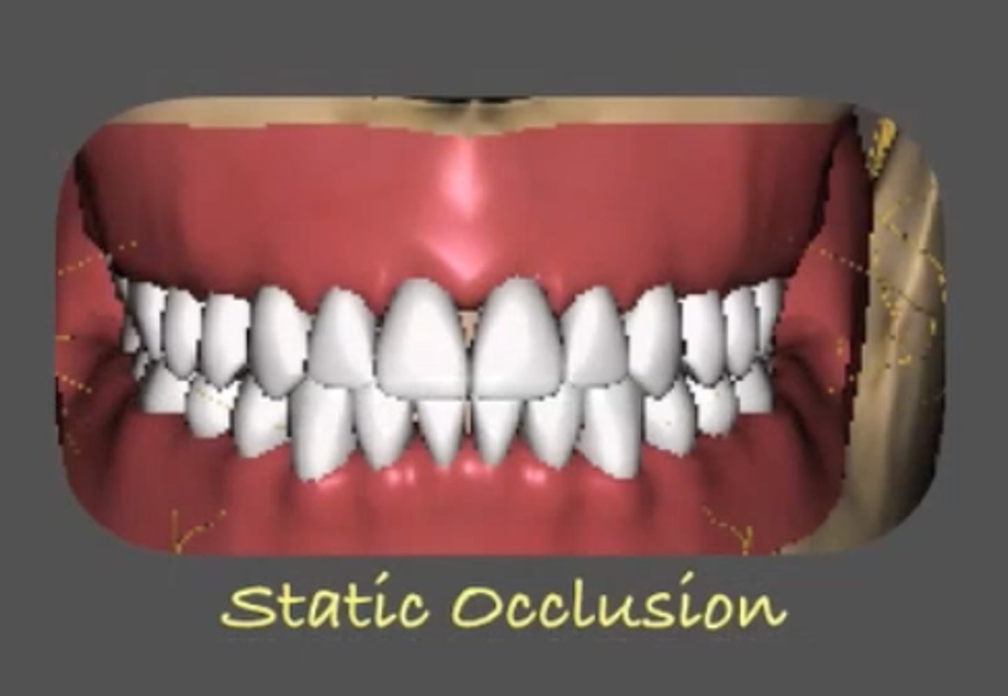<p>How the teeth contact when closing in centric occlusion or centric relation</p>
