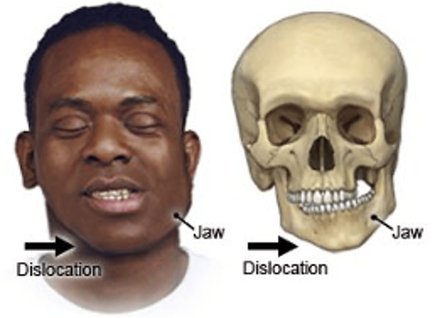 <p>• Can be unilateral or bilateral as well as chronic or acute</p><p>.• Dislocation involves the disarticulation of the mandibular condyle and the temporal bone</p><p>.• Anterior dislocation is most common</p>
