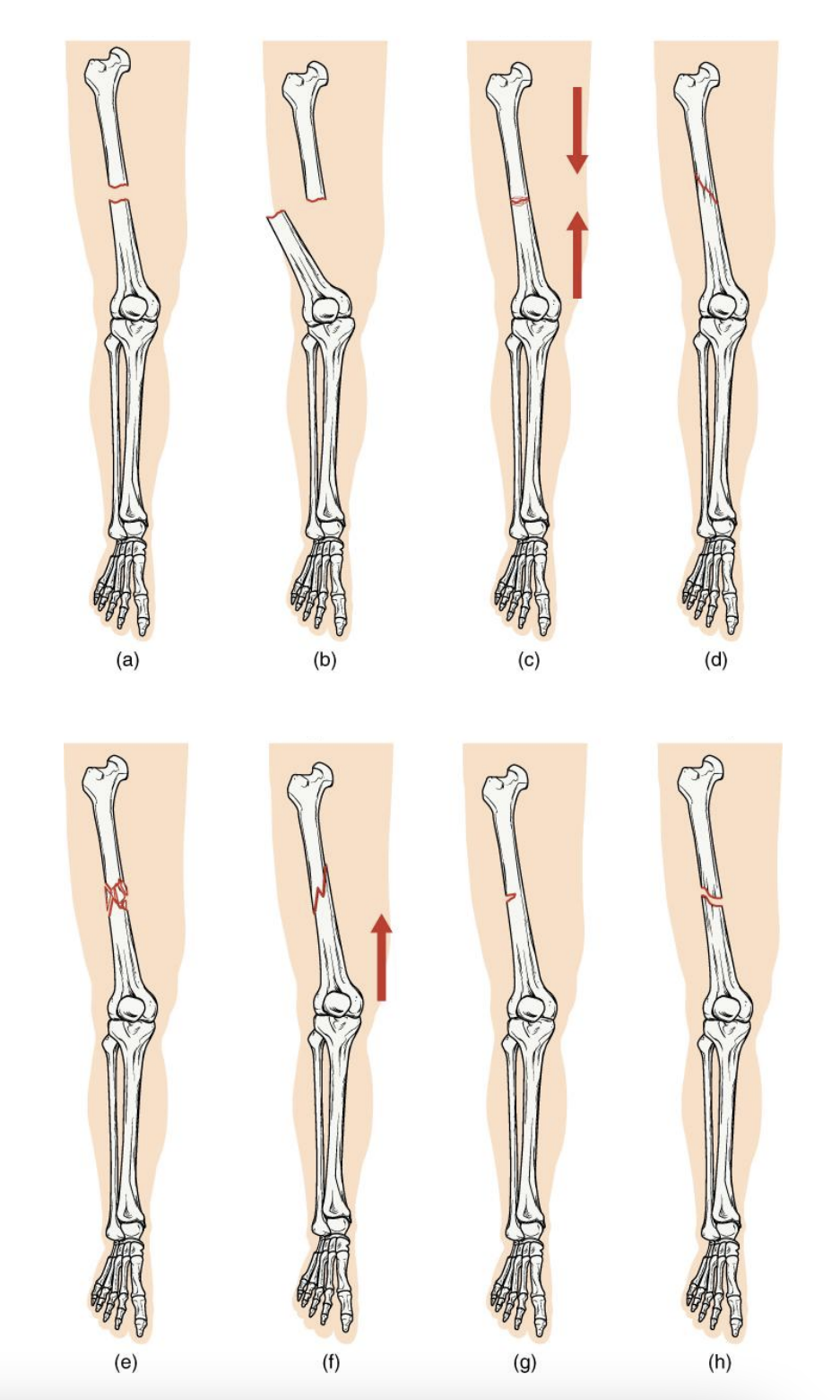 [Bone Fracture] several breaks in one bone