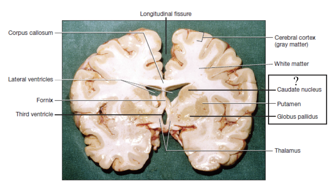 <p>striped masses of gray matter buried deep in the white matter lateral to the thalamus and are involved in motor control</p><ul><li><p>caudate nucleus: superior and medial</p></li><li><p>putamen: lateral</p></li><li><p>globus pallidus: inferior and medial</p></li></ul><p></p>