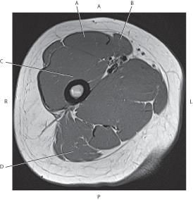 <p>Which line is pointing to the rectus femoris muscle?~</p>