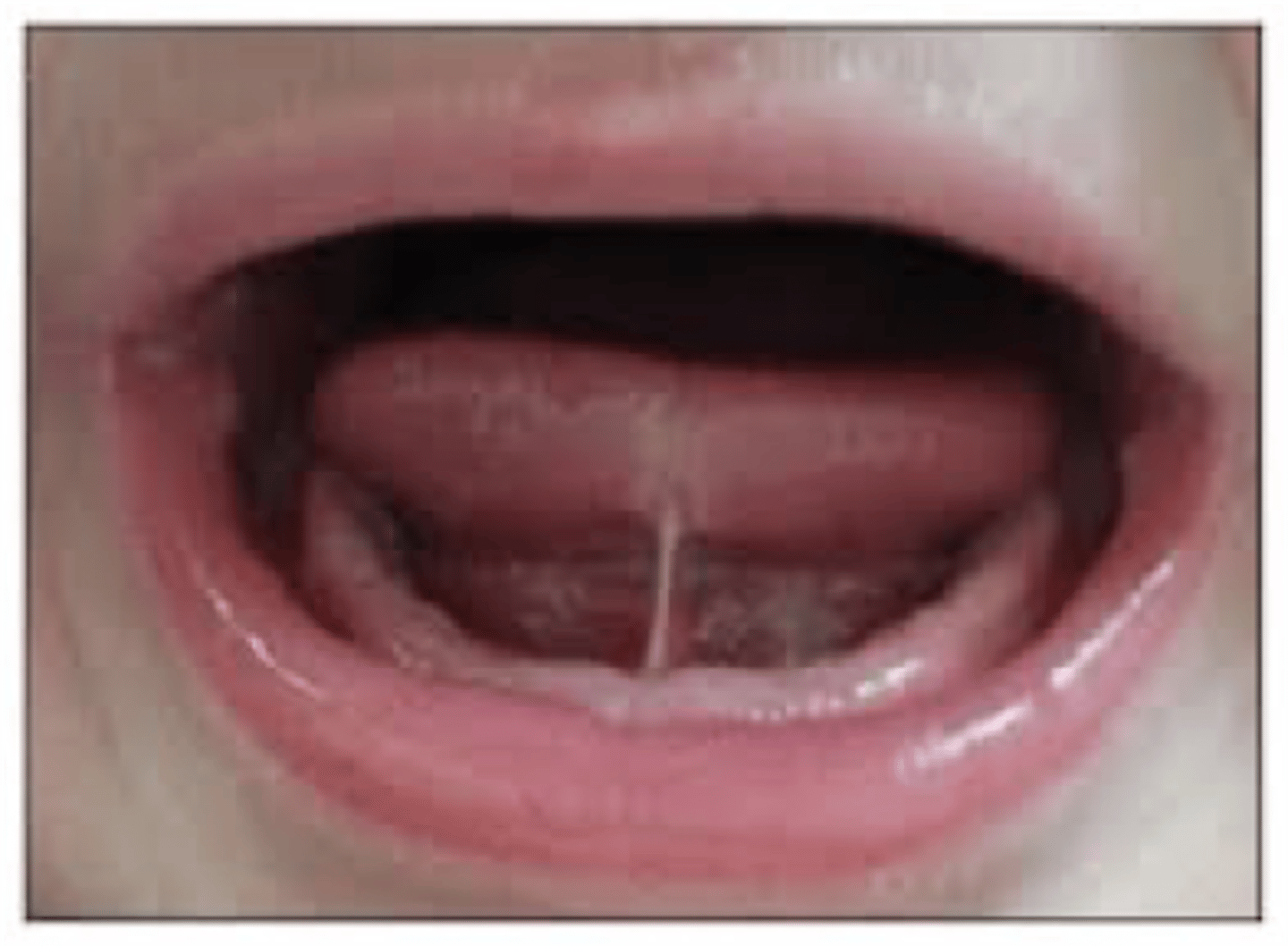 <p>ankyloglossia</p>