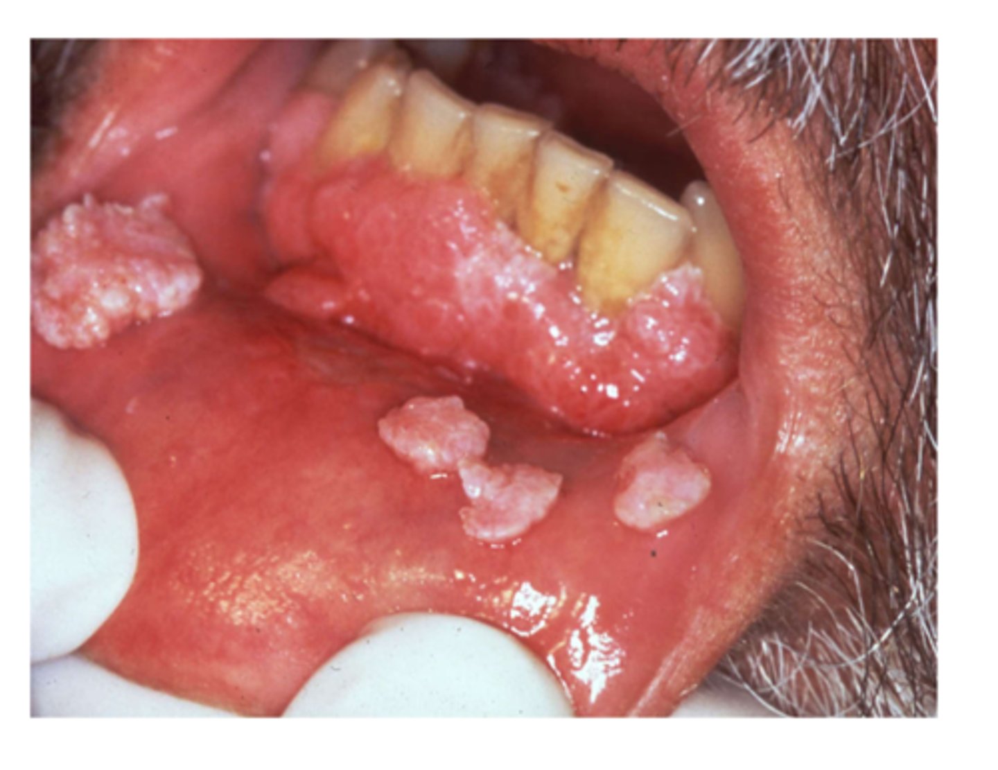 <p>treatment for which benign epithelial lesion:</p><p>• Conservative surgical excision</p><p>• Vaccine for prevention</p>