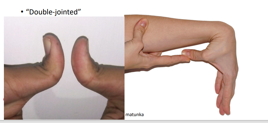 <ul><li><p>it is not two joints, just anatomy that allows it </p></li><li><p><span>Different from Ehlers-Danlos Syndrome where the joint connectivities are already loose w/ symptoms of loose joints, skin and connective tissue</span></p></li></ul><p></p>
