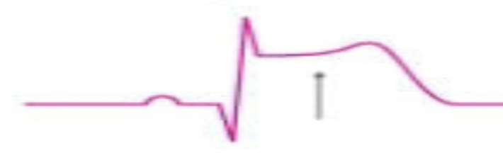 <p>What is the rhythm?</p>