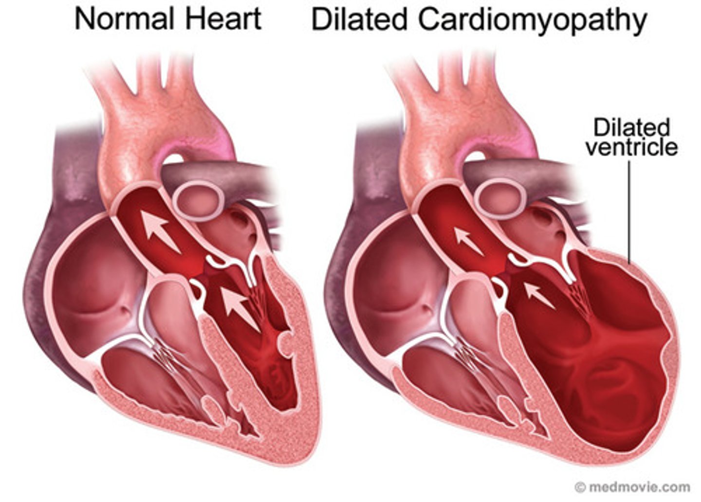 <p>- dilated left ventricular hypertrophy greater with systolic HF (heart can't pump)</p><p>- an adaptive increase in muscle mass and heart wall thickness, initially effective</p><p>- over time leads to poor contractility, increased O2 needs, poor coronary artery circulation, and risk for dysrhythmias</p>
