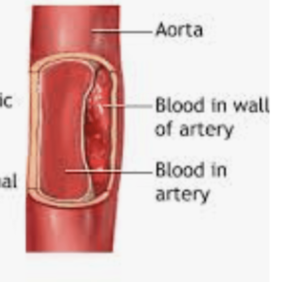 <p>A condition in which the inner layers of an artery allowing blood (at high pressures) to flow between the layers.</p>