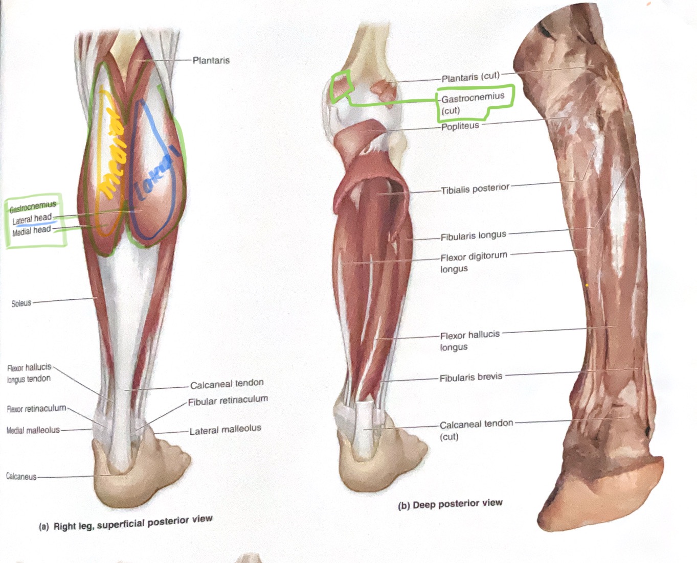 <p>Origin: Medial head- posterior side of medial condyle of femur </p><p>Lateral head- Posterior side of lateral condyle femur</p><p>Insertion: Calcaneus</p><p>Action: Flex knee; Plantar flex ankle</p>