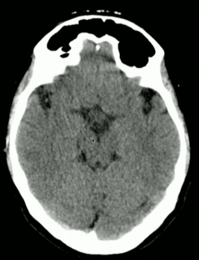 <p>What Part of Brain stem?</p>