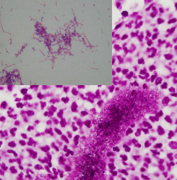 <p><span>Nocardiosis</span></p>