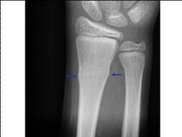 <p>Impacted fracture</p>