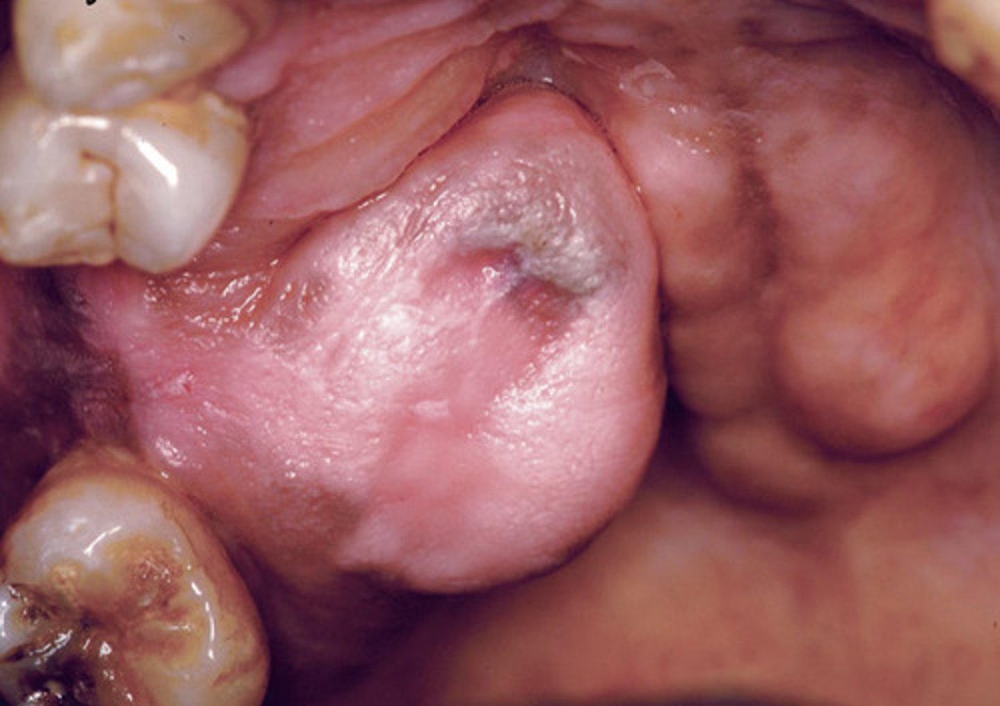 <p>Very round cortical expansion of maxilla</p>