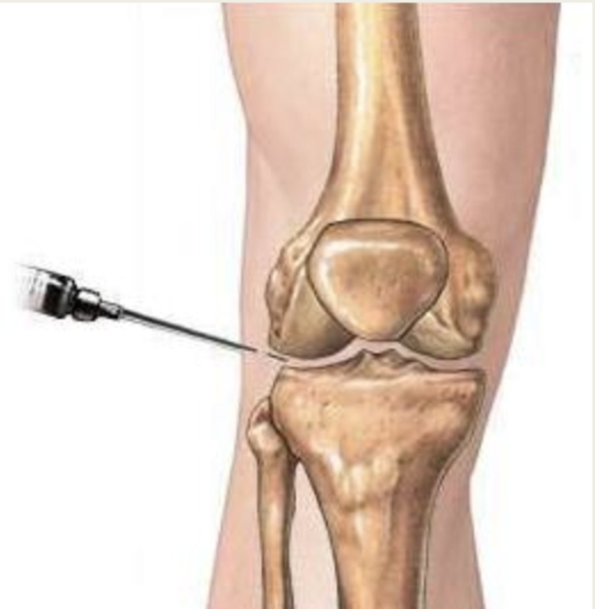 <p>Arthrocentesis</p>