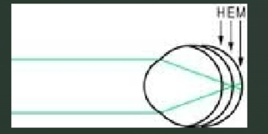 <p>we are generating axial ametropia </p><ul><li><p>when light located at E light from the distant object is fomred on the retina </p></li><li><p>when retina is moved further away from the front of the eye ( longer axial length) eye becomes myopic M</p></li><li><p>when retina moved closer then eye becomes hyperopic H</p></li></ul><p></p>