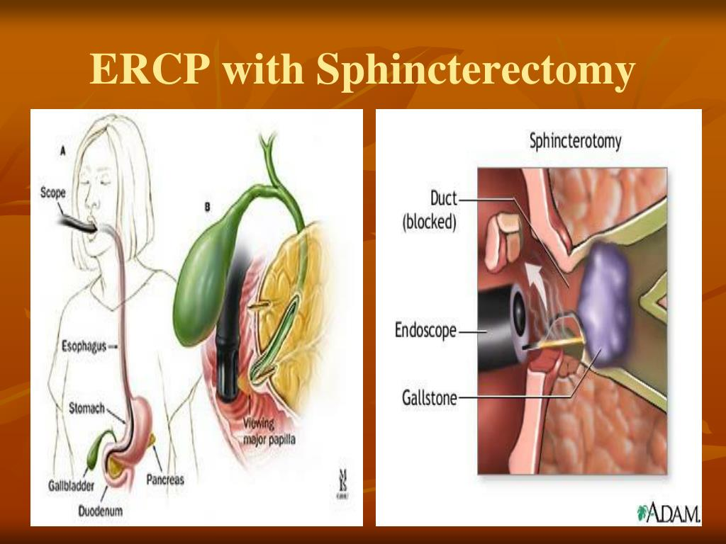 <ol><li><p><span style="color: rgb(121, 170, 250);"><strong>ERCP</strong></span></p></li></ol><ul><li><p><span style="color: rgb(121, 170, 250);"><strong>removes gallstones</strong></span> blocking pancreatic duct</p></li></ul><p></p><ol start="2"><li><p><span style="color: rgb(15, 177, 19);"><strong>Cholecystectomy</strong></span></p></li></ol><ul><li><p>if <strong>result </strong>of cholecystitis/gallstones</p></li></ul><p></p><ol start="3"><li><p><span style="color: rgb(181, 108, 228);"><strong>Sphincterotomy:</strong></span></p></li></ol><ul><li><p><span style="color: rgb(181, 108, 228);"><strong>enlarges</strong></span><strong>&nbsp;</strong>pancreatic duct</p></li></ul><p></p><ol start="4"><li><p><span style="color: rgb(245, 80, 80);"><strong>Pancreatojejunostomy:</strong></span></p></li></ol><ul><li><p><span style="color: rgb(245, 80, 80);"><strong>reroutes</strong></span><strong> </strong>pancreatic secretion to jejunum</p></li></ul><p></p>