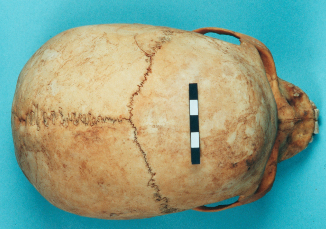 <p><span>What is the score for the coronal and sagittal sutures of this skull?</span></p>