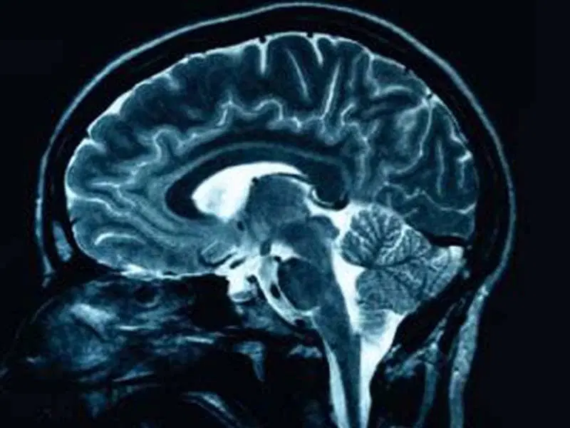 <p>MRI</p>
