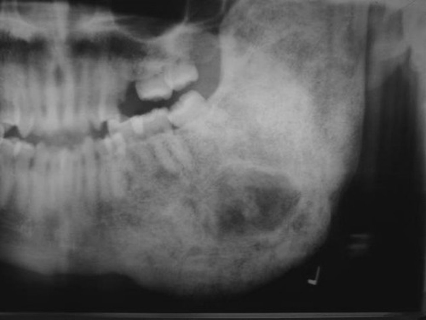 <p>localized change in normal bone metabolism, replacement of cancellous bone by fibrous tissue</p>