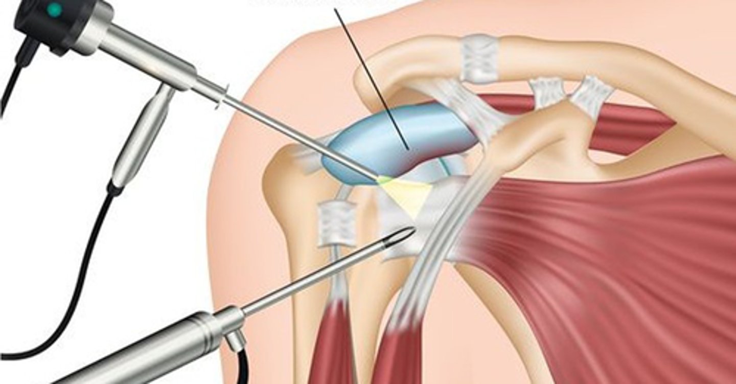 <p>die Gelenkspiegelung</p>