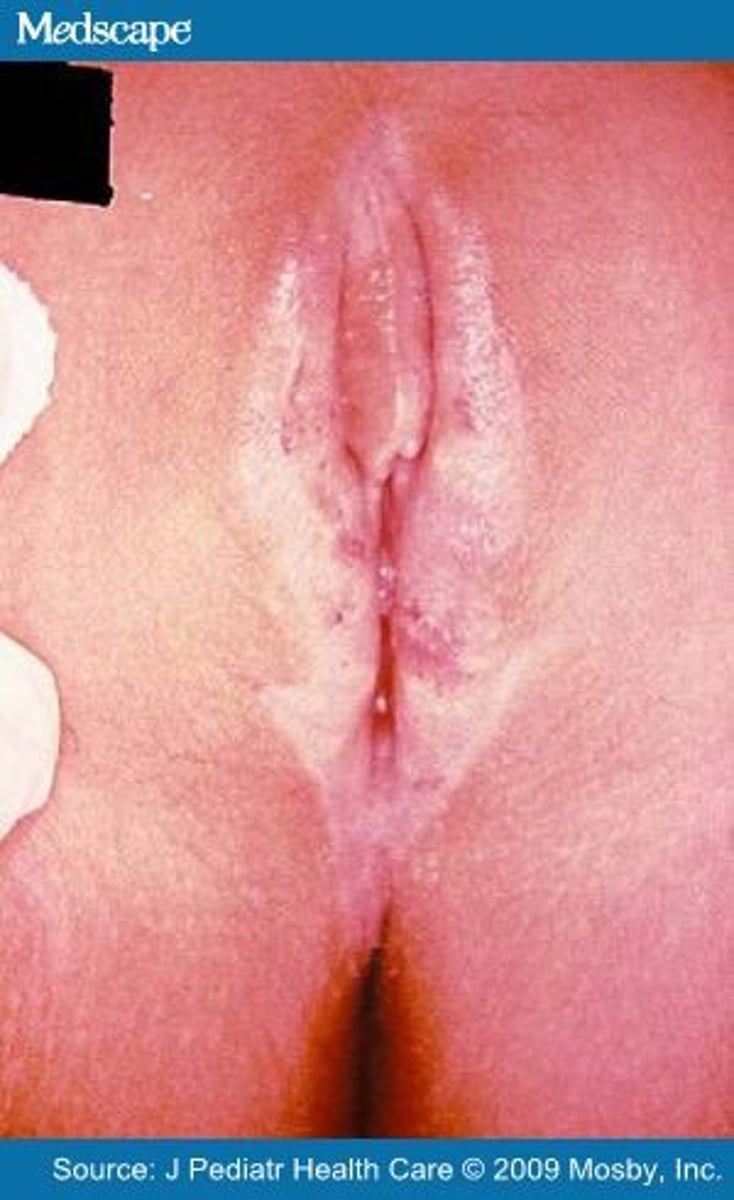 <p>= jeukende witte parelmoer-achtige maculae die evolueren naar een sclerotische atrofische huid met mogelijke klachten van phimosis, dyspareünie of obstipatie</p>