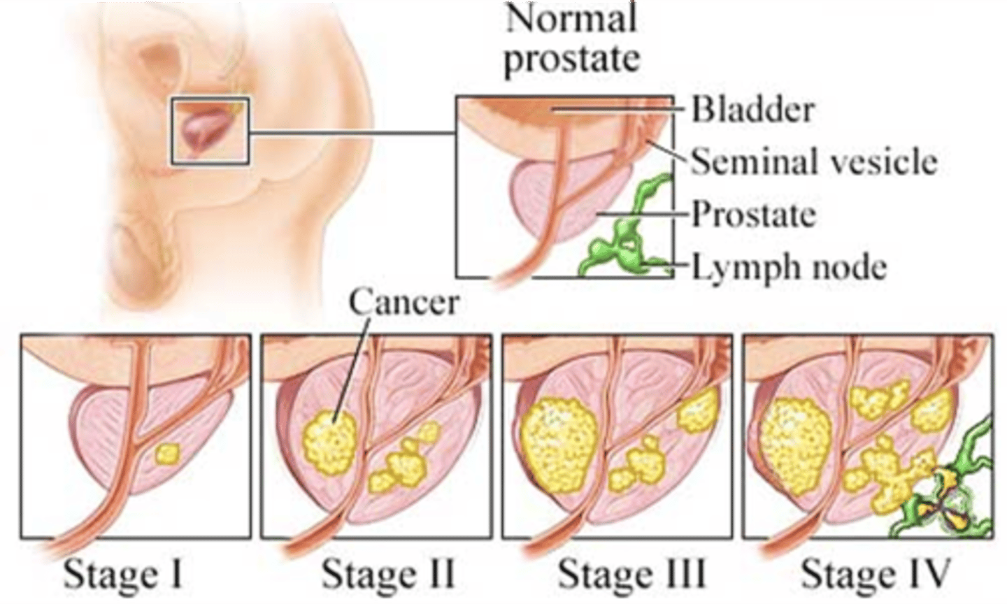 <p>Stage I: Small and only in prostate</p><p>Stage II: Still within prostate but larger and may involve both sides of the prostate</p><p>Stage III: Cancer has spread beyond the prostate to nearby tissues</p><p>Stage IV: Cancer has spread to distant parts of the body such as lymph nodes</p>
