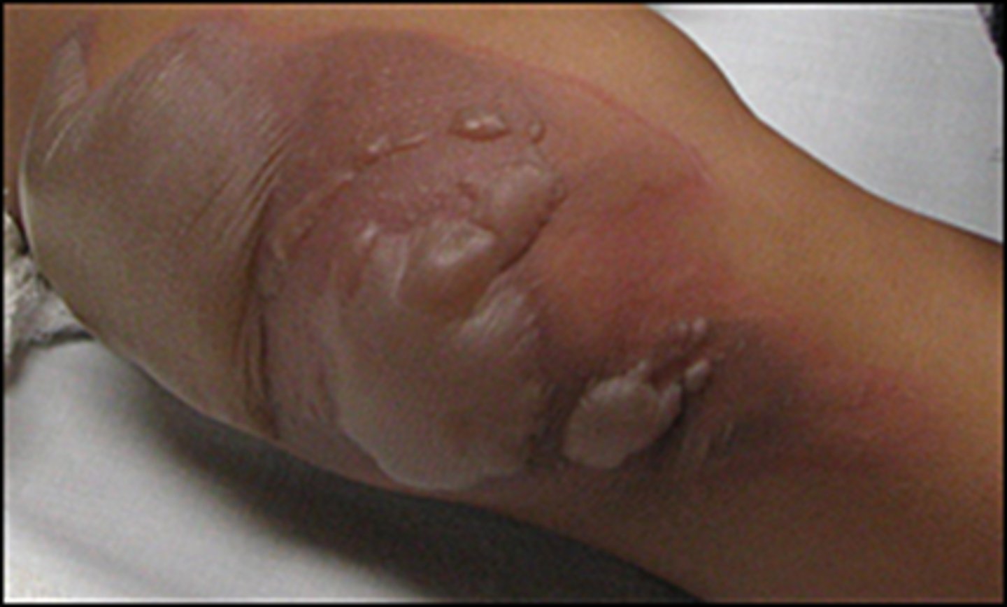 <p>Epidermis and partial dermis damage. Lose skin function, but sweat and hair not damaged. Characterized by pain, edema, and takes 3-4 weeks to heal.</p>