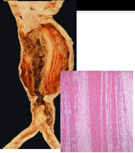 <p>Lines of Zahn are produced by alternating pale layers of platelets admixed with fibrin and darker layers containing more red cells.</p>