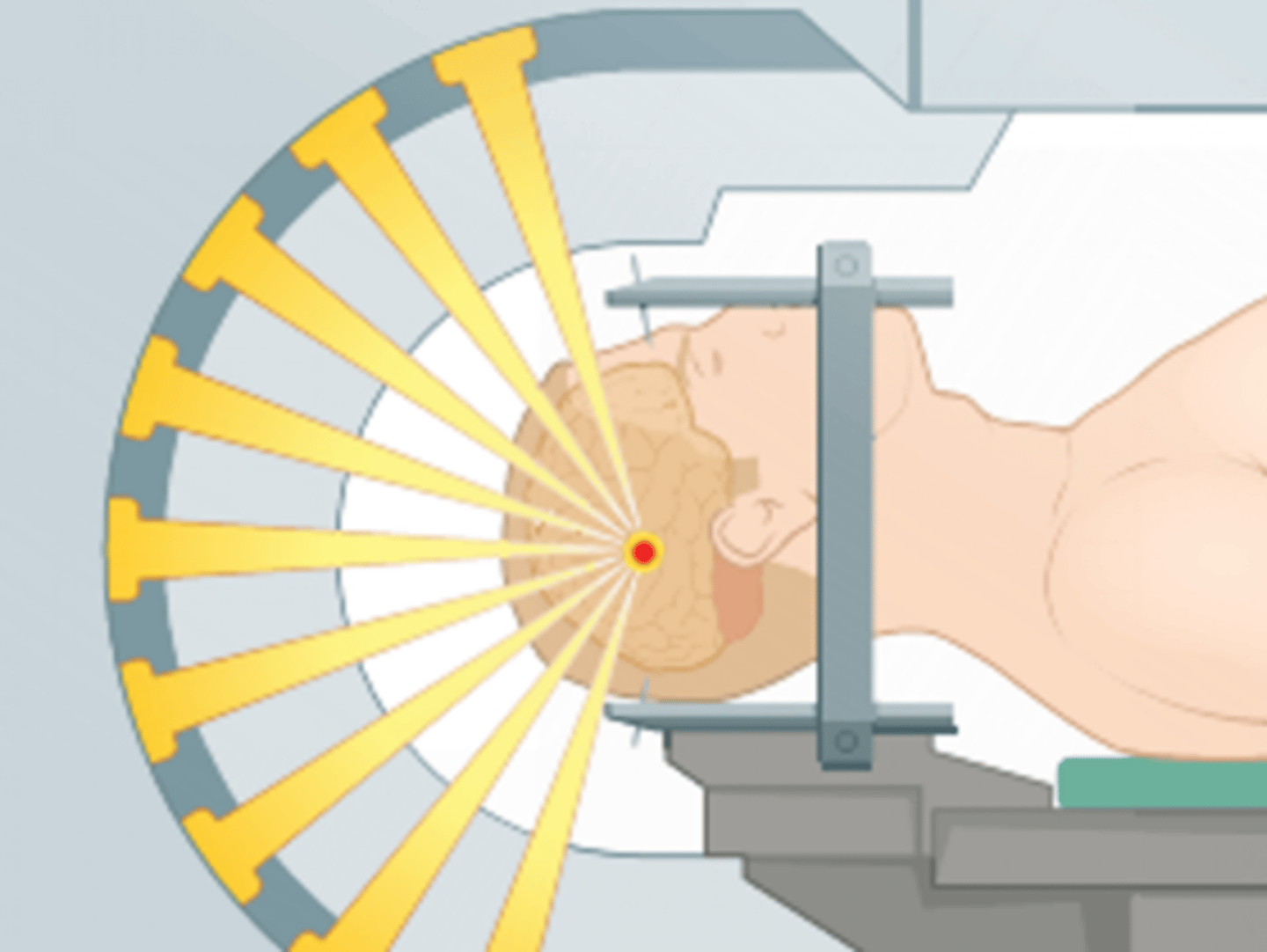 <p>a minimally invasive surgical technique that uses a three-dimensional (3D) imaging system to precisely target specific areas in the brain or other parts of the body. It enables surgeons to reach deep areas with great accuracy, often without making large incisions</p>
