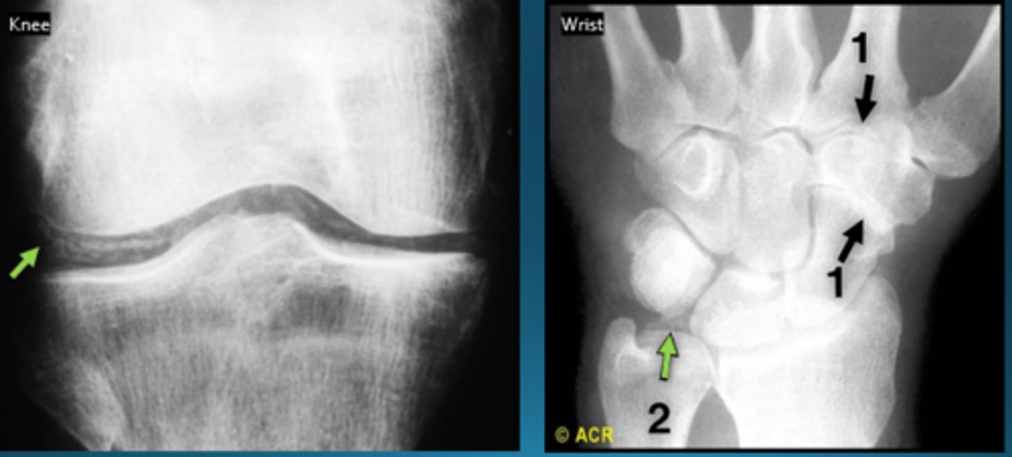 <p>calcium pyrophosphate dehydrate deposition (CPDD) - may mimic OA - differentiated bc isolated or disproportionate patellofemoral OA with chondrocalcinosis</p>
