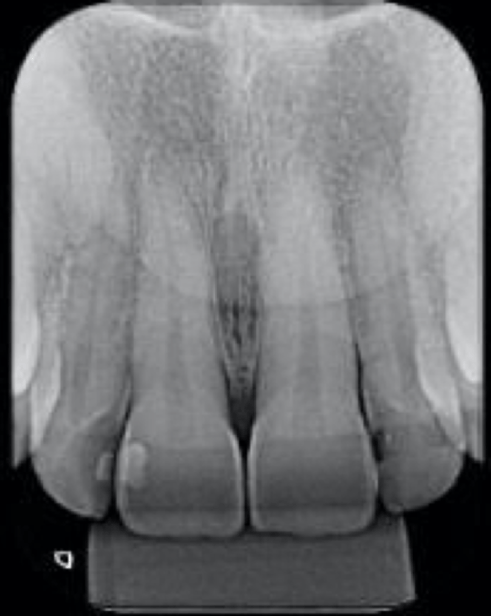 <p>ID the pulpal diagnosis:</p><p>- Pt has no symptoms</p><p>- Cold test: 1-2 seconds</p><p>- No intra-oral findings</p>