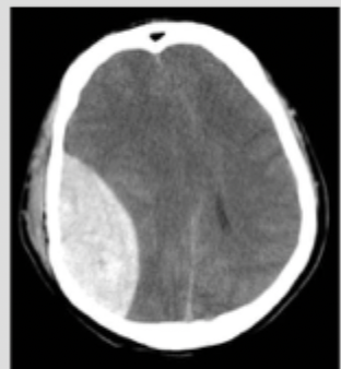 <p>What type of intracranial hemorrhage is characterized by LOC with a blow to the head followed by a lucid period and then a mental decline</p>