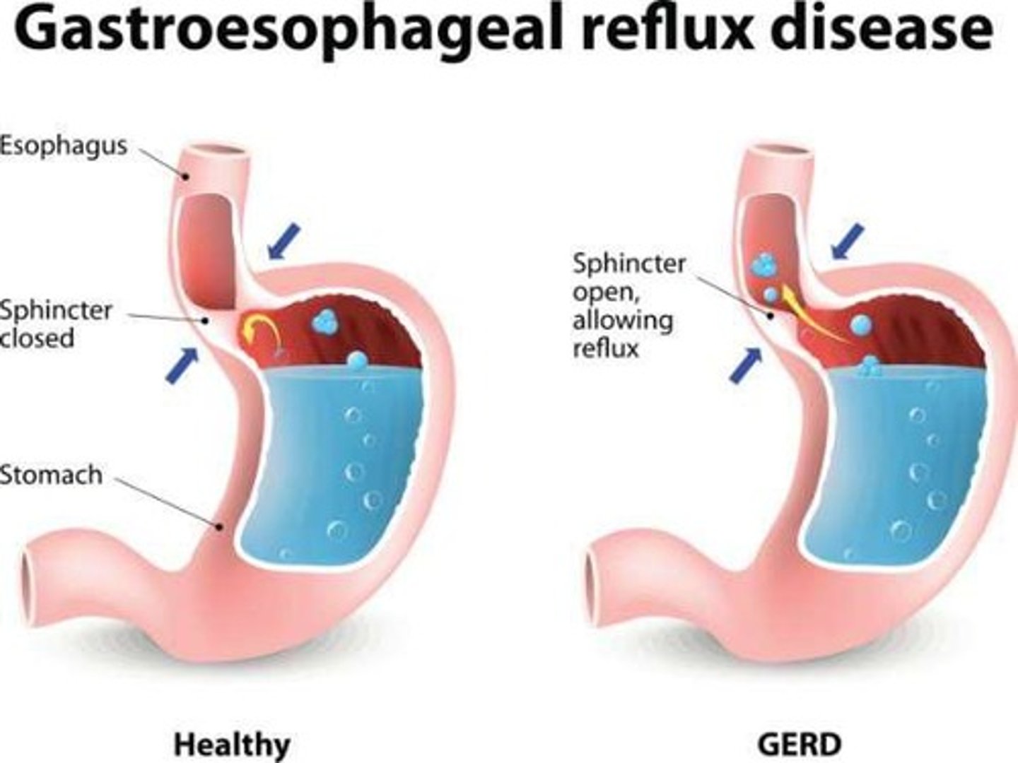 <p>Reflux of gastric contents into the esophagus.</p>