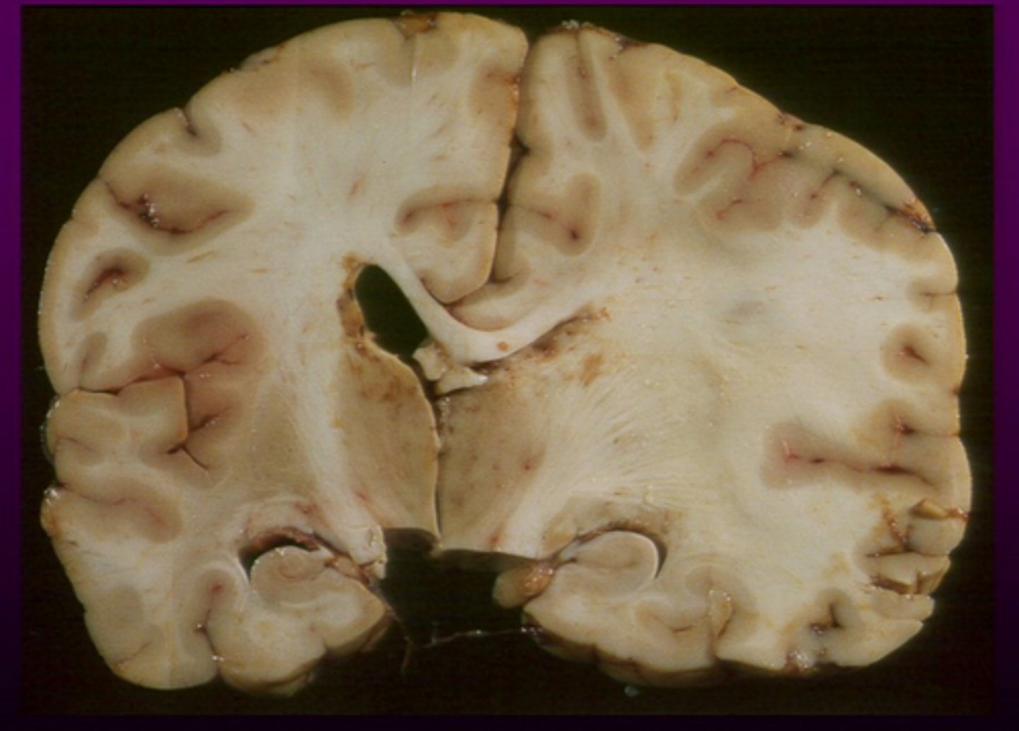 <p>herniation in which the cingulate gyrus crosses the midline, passing under the falx cerebri to compress the contralateral cerebral hemisphere</p>