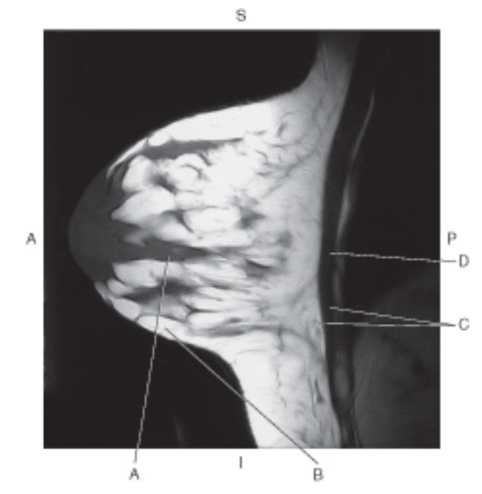 <p><span>In the figure below of a sagittal, T1-weighted MRI of the breast, which line points to the glandular tissue?</span></p>