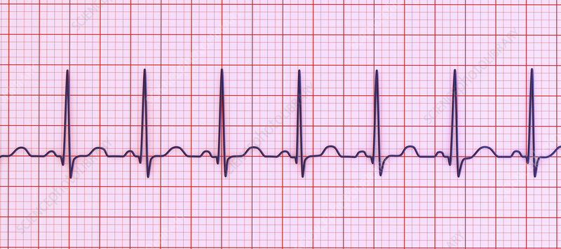<p>fast heart rate (>100 bpm) </p>