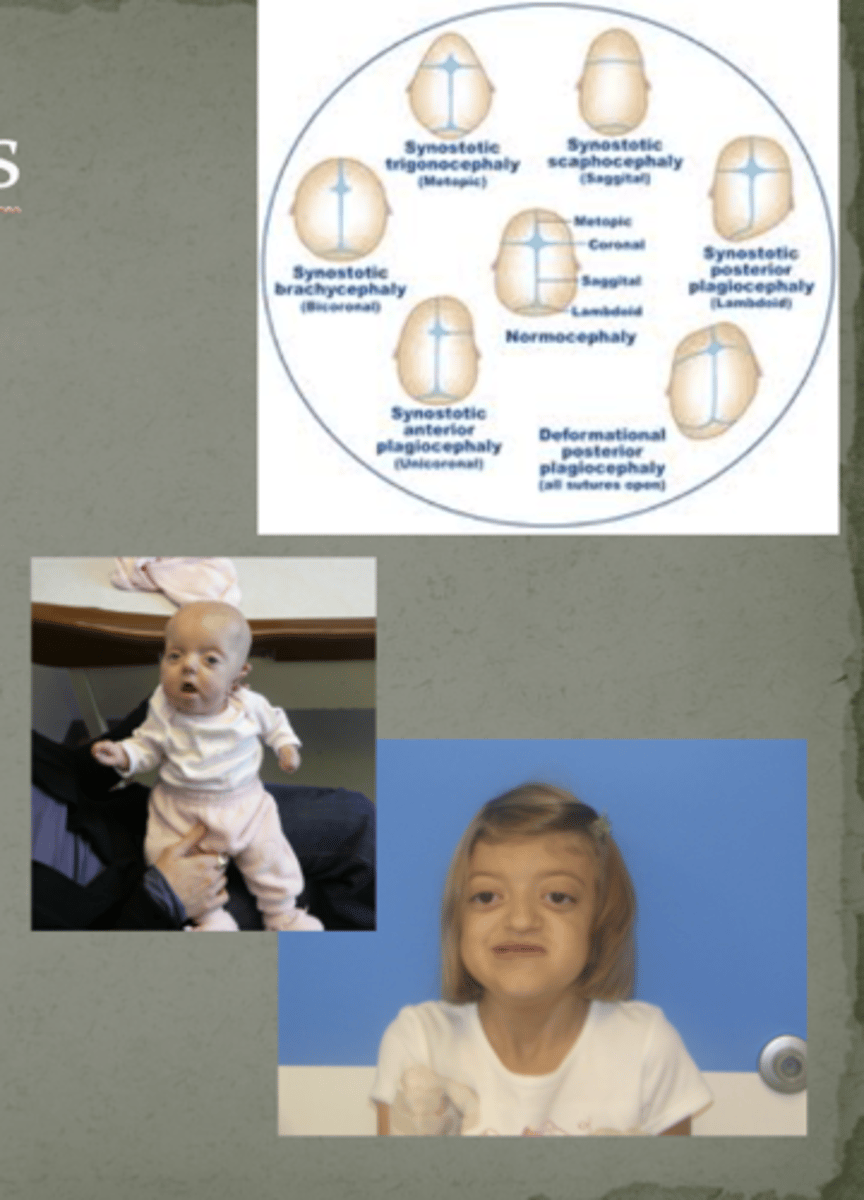 <p>Craniosynostoses</p>