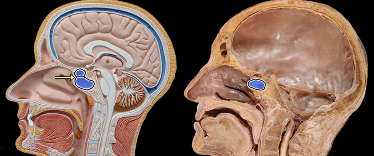 <p>Sphenoidal sinus</p>